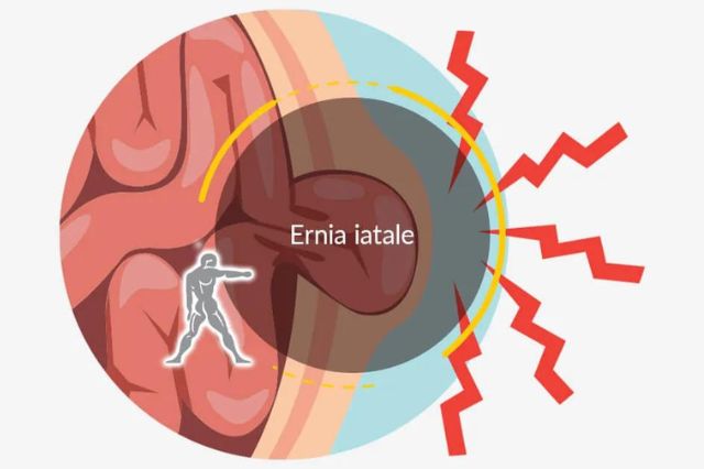 Clicca per accedere all'articolo Sabato 20 maggio: "Ernia iatale e malattia da reflusso gastroesofageo" 