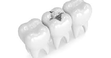 Clicca per accedere all'articolo Sanzioni per gli odontoiatri che utilizzano amalgama dentale